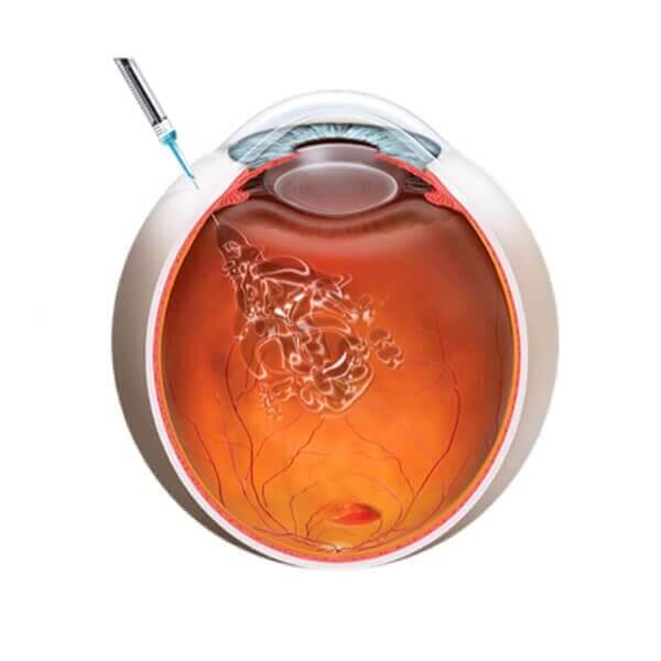 Personalizovano liječenje mrežnjače